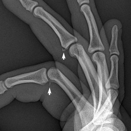 Small volar plate fractures may be easily overlooked if one does not specifically search for them. Case 1 18 Volar plate fractures 17-year-old man with finger injury, relocated in the field.