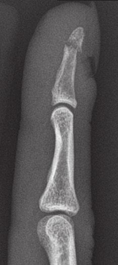 Chew and Maldjian Case 1 2 Phalangeal tuft fracture 42-year-old man whose thumb was crushed by a tie-down chain while unloading a truck. PA radiograph of the right thumb.