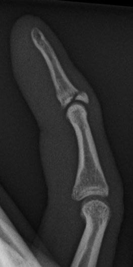 Case 1 5 Mallet finger 17-year-old man who jammed his small finger. Lateral radiograph of the right small finger.