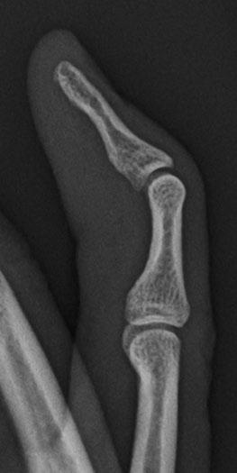 Chew and Maldjian Case 1 6 Mallet finger 27-year-old man who injured his small finger several months ago. Lateral radiograph of the right small finger.