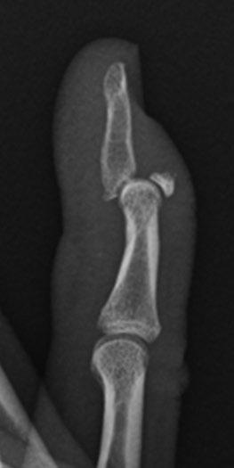 Rupture of the common extensor tendon results in unopposed flexion at the DIP joint, with the flexed distal phalanx likened to a mallet.