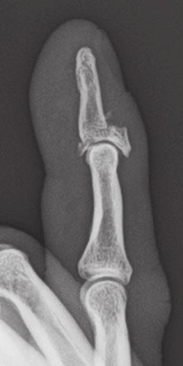 Fingers Case 1 8 Complete articular fracture of the distal phalanx (C)