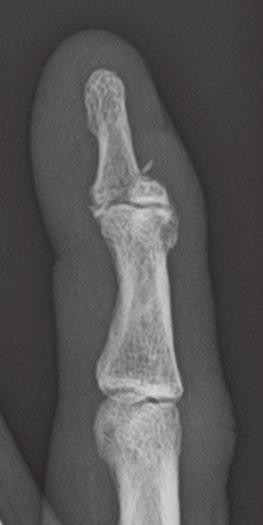 surface of the distal phalanx at the DIP joint.