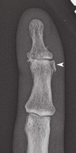 (arrowhead). (D) Axial CT through the DIP of the right small finger.