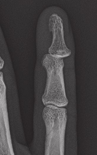Chew and Maldjian Case 1 9 Dorsal DIP dislocation 31-year-old woman who jammed her finger