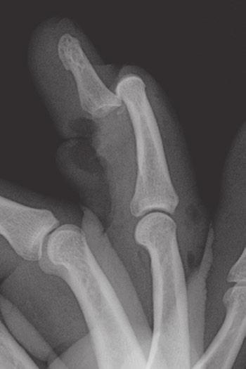 Case 1 10 Volar DIP dislocation 47-year-old man with a crush injury to the ring finger.