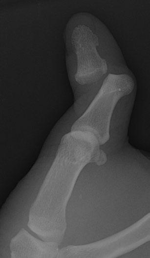 Fingers Case 1 11 Thumb dislocation 46-year-old man who injured his hand in an altercation.