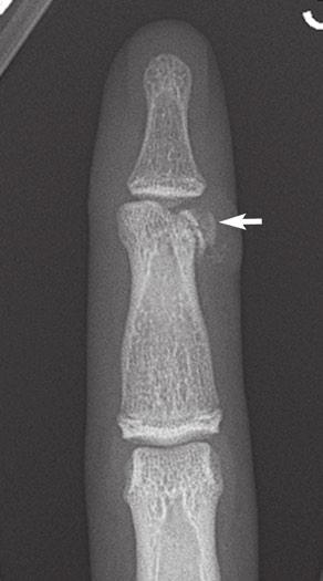 There is dislocation of the thumb IP joint with dorsolateral dislocation of the distal phalanx. These are uncommon injuries.