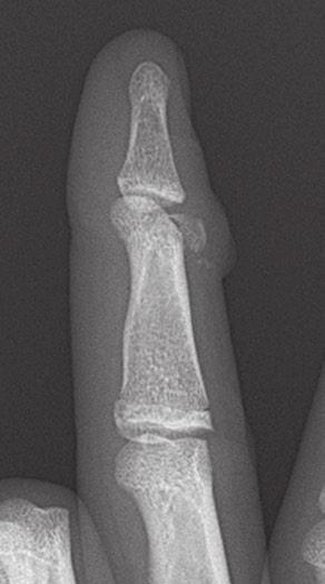 A ruptured palmar plate or tendon can become interposed into the joint preventing nonsurgical reduction [ 7 ].