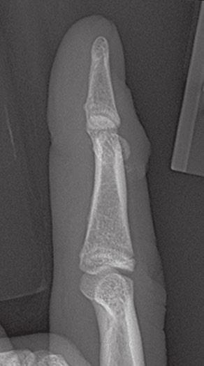 PA, oblique, and lateral (C) radiographs of the right middle finger.