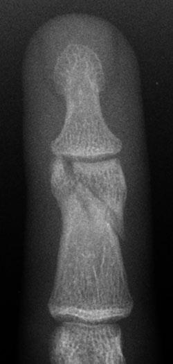 Chew and Maldjian Case 1 13 Oblique phalanx fracture 25-year-old man injured his hand playing football. PA radiograph of the right ring finger.