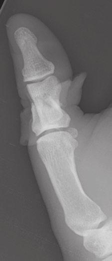 Lateral, oblique, and PA (C) radiographs of the right thumb. There is a near amputation with fracture through the proximal phalanx.