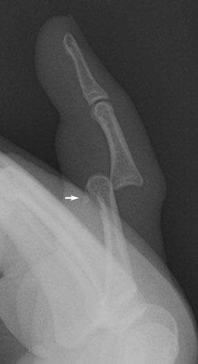 Fingers Case 1 15 Dorsal PIP dislocation 18-year-old man injured finger playing basketball. Lateral radiograph of the left small finger. There is dorsal dislocation of the middle phalanx.