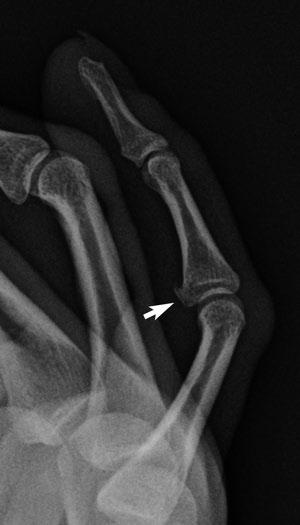 PIP joint dislocations are the most frequent dislocations in the hand. Mechanism of injury for dorsal PIP dislocation is forced hyperextension with axial compression.