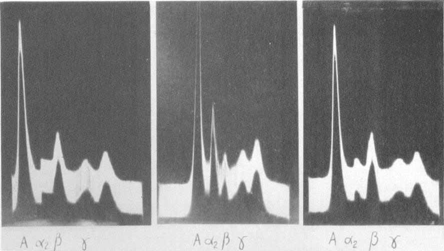 of heparin (middle pattern) the beta-i globulin peak has decreased in size and the alpha-2 peak has increased.