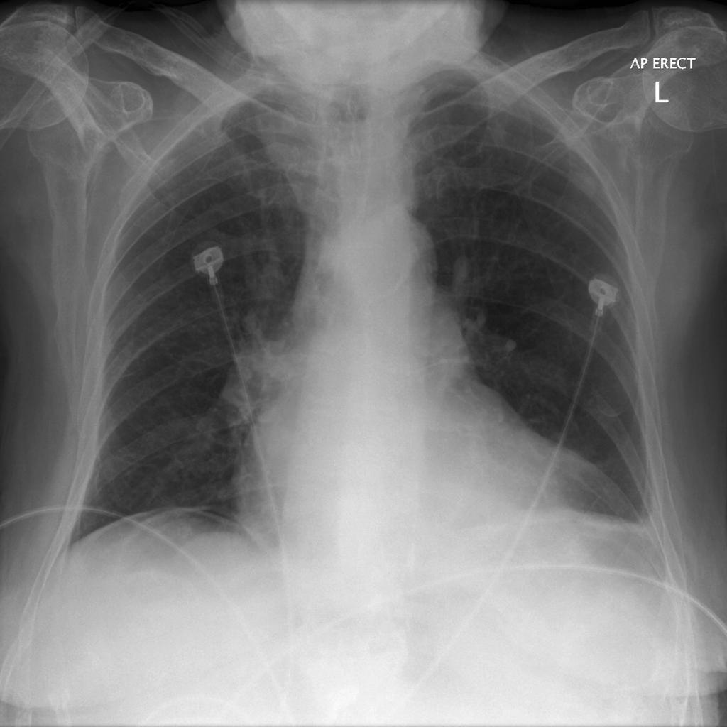 i. What is the one (1) most obvious abnormality on the CXR (1 mark) ii.