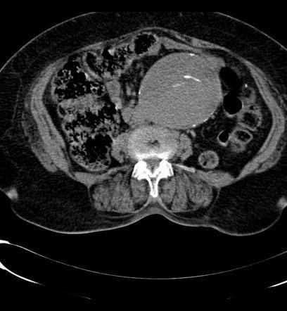 ii. What is the most striking abnormality on the CT (1 mark) The diagnosis is