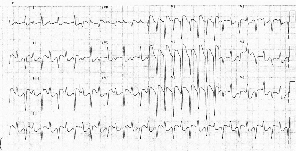 ph 7.10 pco2 79 HCO3 12 Lactate 9.0 Na 124 K 8.0 Cl- 98 ii. What is the abnormality seen on the ECG (1 mark) iii.