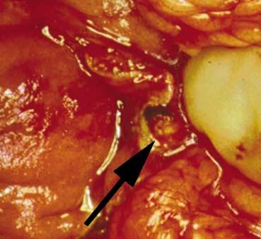 Here the arrow denotes the small duodenal primary. Fig.