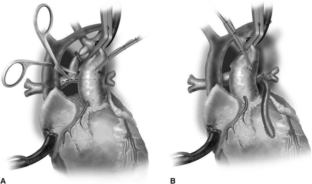 Hemi-Fontan procedure 125 slightly decreased in the immediate perioperative period, by discharge the vast majority of patients have returned to a normal sinus rhythm, which is maintained.