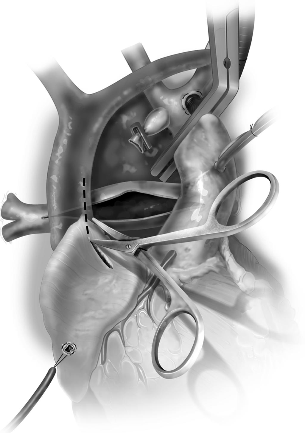 Hemi-Fontan procedure 127 Figure 3 An incision is then made in the anterior aspect of the right atrial appendage and the incision then carried medially across the cavoatrial junction for