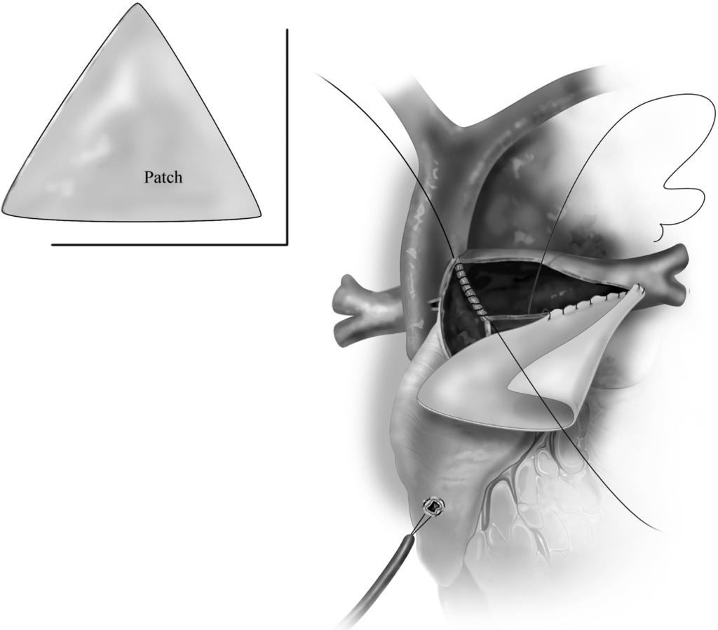 Hemi-Fontan procedure 129 Figure 5 A patch of pulmonary homograft material is cut in a wide triangular shape with as broad a base as possible.