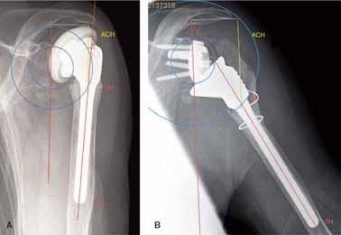 Revision to reverse shoulder arthroplasty with retention of the humeral component 14