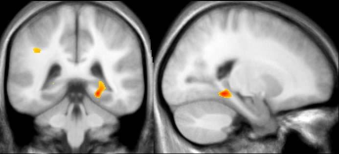 Automated whole-brain analysis (VBM8) right parahippocampal gyrus left hippocampus Areas with lower grey matter in
