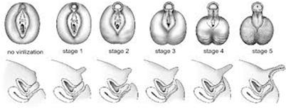 CAH Presentation in Neonate Varying degrees of ambiguous genitalia in female newborns. Newborn males may have subtle penile enlargement.
