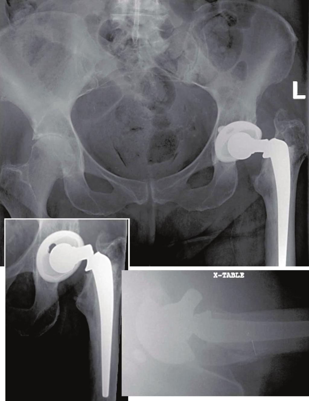 2 Case Reports in Orthopedics Figure 1: Admission radiographs show femoral component fracture at the neck-shoulder junction at 12 years after implantation. was unaffected.
