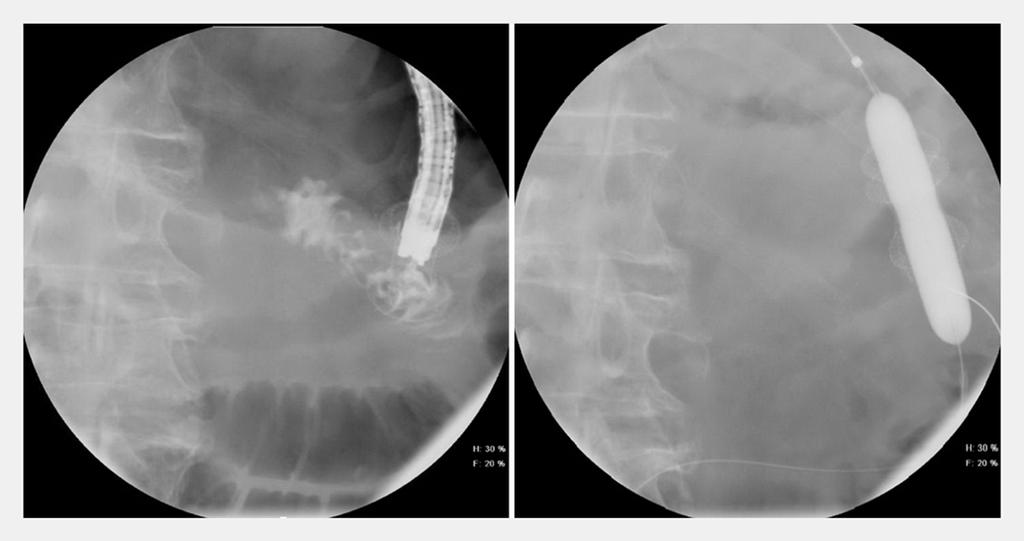 Fig.2 Balloon dilation. Fig.3 Post-Axios stent deployment and balloon dilation.