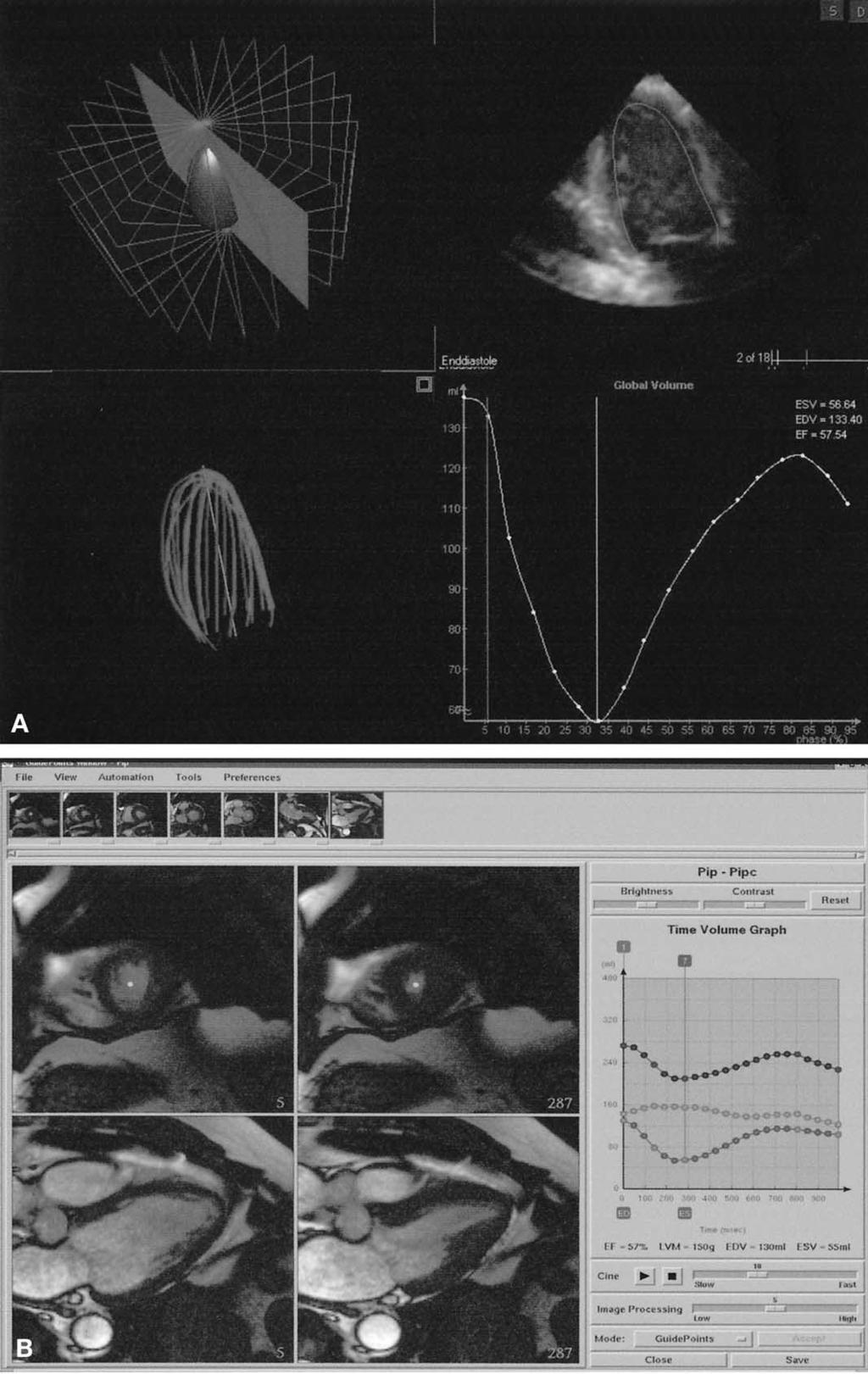 880 Jenkins et al. JACC Vol. 44, No. 4, 2004 Reproducibility and Accuracy of 3DE August 18, 2004:878 86 Figure 1. (A) Analysis of left ventricular (LV) volume using three-dimensional echocardiography.