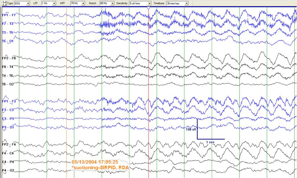Continuous EEG Monitoring
