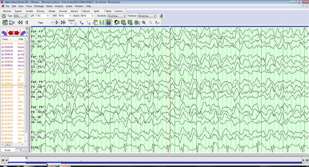 EEG During Propofol Wean: Generalized