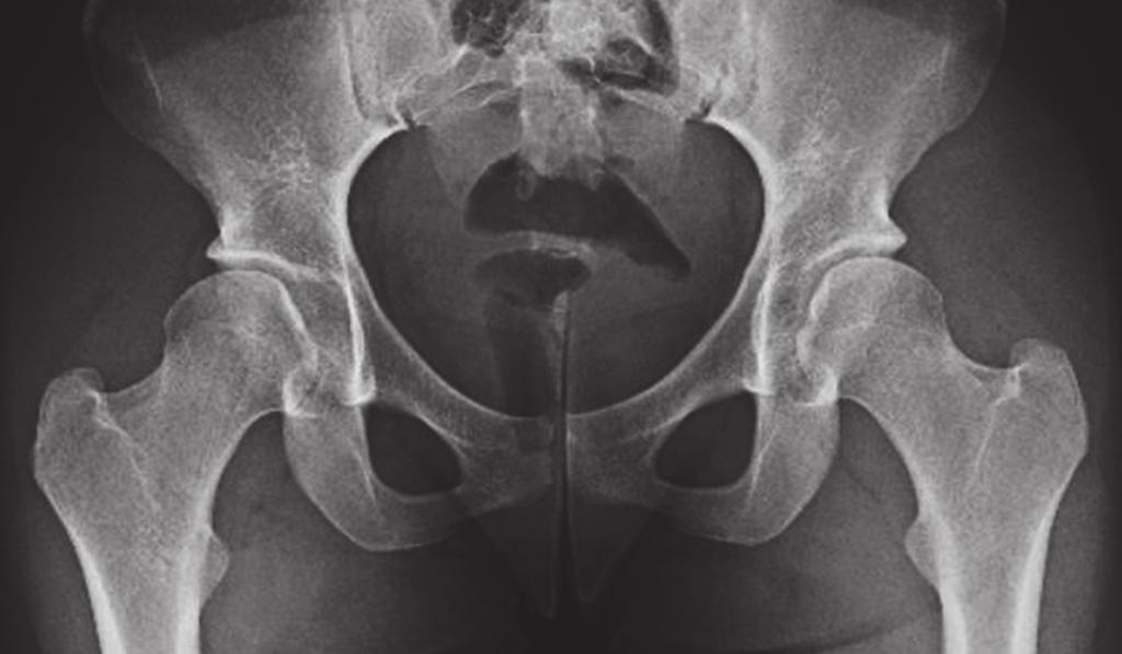 ARTHROSCOPY OF THE HIP FOR PATIENTS WITH MILD TO MODERATE DDH AND FEMOROACETABULAR IMPINGEMENT 1317 Fig. 1a Fig.