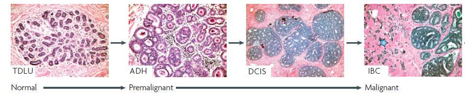 Natural history of breast cancer: transformation of the TDLU Terminal duct lobular unit (TDLU) Atypical ductal hyperplasia (ADH)