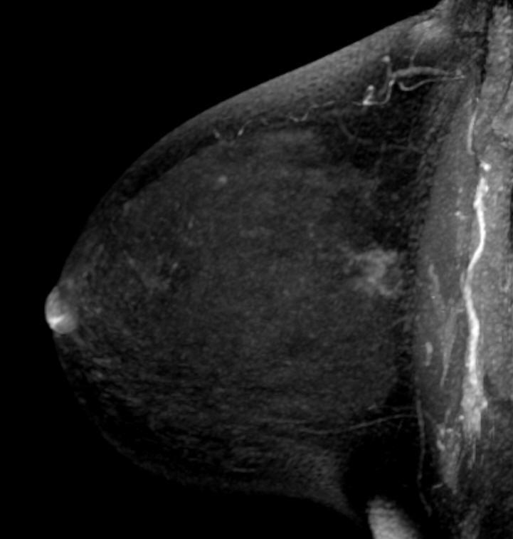 0cm Breast, left, BCS; Infiltrating Duct Carcinoma -Post-neoadjuvant chemotherapy status -Invasive tumor size: 1.8x1.