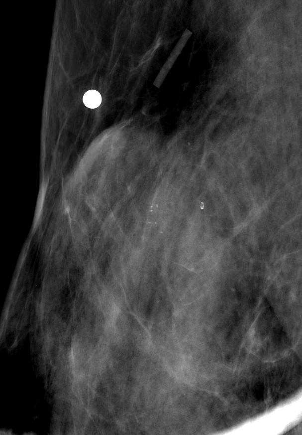 ER + Case, 43/F, BCS after NAC Breast, right excision DCIS, comedo and noncomedo, residual with -Post-neoadjuvant chemotherapy, BCS