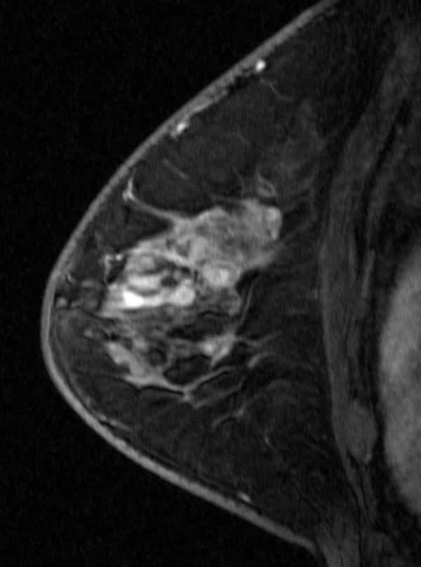Lesion to Background SER in Distinguishing Residual Tumor vs. No Residual Tumor Mean SER: residual tumor (minimally invasive tumor plus DCIS)>no residual tumor (1.72±0.40 vs. 1.49±0.32, P<0.001).