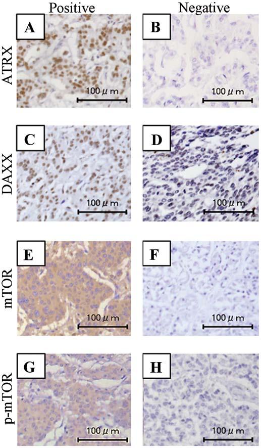 2756 sato et al: Tumor microenvironment analysis of pancreatic neuroendocrine tumors Figure 1.