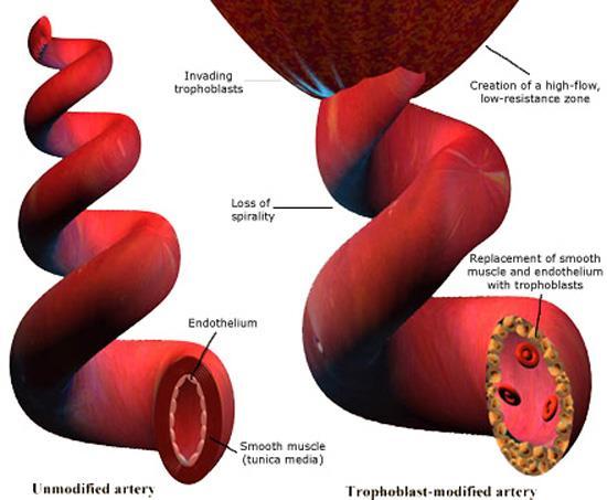 Pre-eclampsia Unmodified artery Trophoblast-modified artery The process of spiral