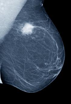 Mammogram Breast Self Exam MRI Genetic Testing
