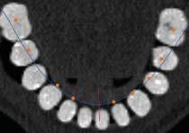 Fig 6a (Above) Occlusal view of a presurgical plan. Note that the orange dots representing the trajectory of the planned position of the implants correspond to the axial cut of the radiopaque teeth.