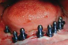Fig 7a Clinical photograph of 8 implants in place.