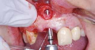 Surgery All at Once : Socket preservation and immediate placement of an implant in an infected site in the anterior region a Case Report The following