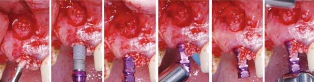 WP va n der Schoor After placement, the emergence profile of the implant was not parallel with the adjacent dentition, and