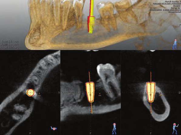 8 Dynamic over Static Real-time navigation is a valuable alternative to stereolithographic (static) guided surgery as it offers the clinician some advantages compared to the former technique.