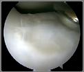 Outcomes Arthroscopic 2, 6, and 13 months