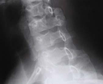 c-spine injury, the