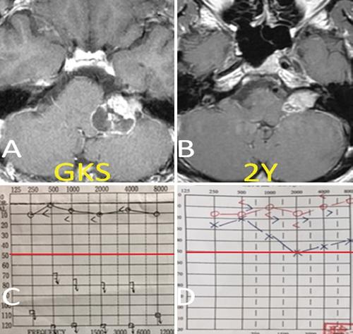Gamma Knife radiosurgery for large vestibular schwannomas FIG. 2. Kaplan-Meier plot showing tumor control rate in cases of large VSs plotted against follow-up time.